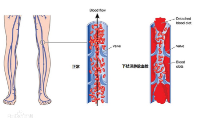 下肢深靜脈血栓